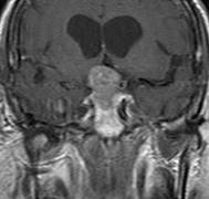 MRI DB Pituitary tumour pre TMZ Jan 08.jpg